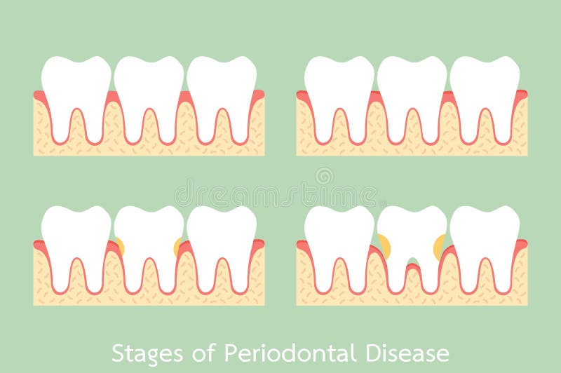 Шаг периодонтального заболевания/заболевания periodontitis/воспаления десен/камеди, зубоврачебной проблемы иллюстрация вектора Шаг периодонтального заболевания/заболевания periodontitis/воспаления десен/камеди, зубоврачебной проблемы иллюстрация вектора