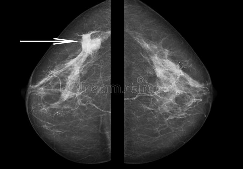 The mammogram is demonstrating the cancer in the breast.The black background is free for your text. The mammogram is demonstrating the cancer in the breast.The black background is free for your text.