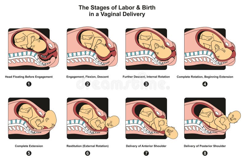 Stages of Labor and Birth in a vaginal delivery infographic diagram including engagement descent internal complete rotation extension poster for medical science education and healthcare. Stages of Labor and Birth in a vaginal delivery infographic diagram including engagement descent internal complete rotation extension poster for medical science education and healthcare