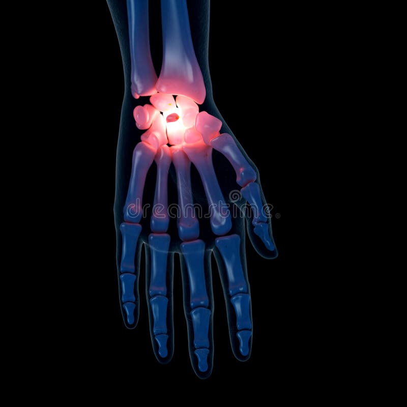 3d rendered medically accurate illustration of a painful wrist. 3d rendered medically accurate illustration of a painful wrist