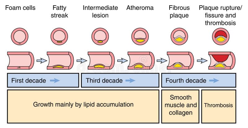 Atheromatous plaque formation in an artery, culmination in plaque rupture, fissure and thrombosis. Atheromatous plaque formation in an artery, culmination in plaque rupture, fissure and thrombosis.