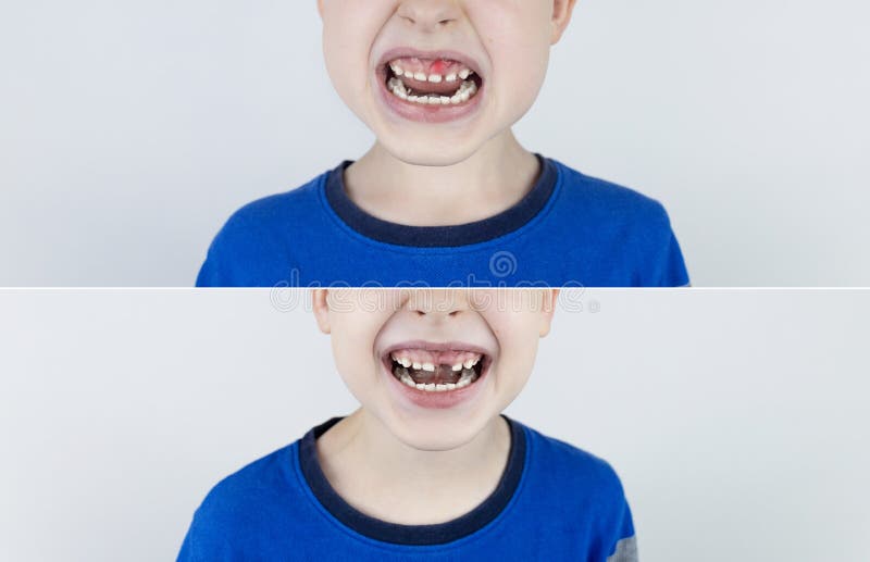 之前和之后. 掉下乳牙. 照片中的金发男孩有一颗松散的乳牙，而在另一张照片中，它已经跌倒