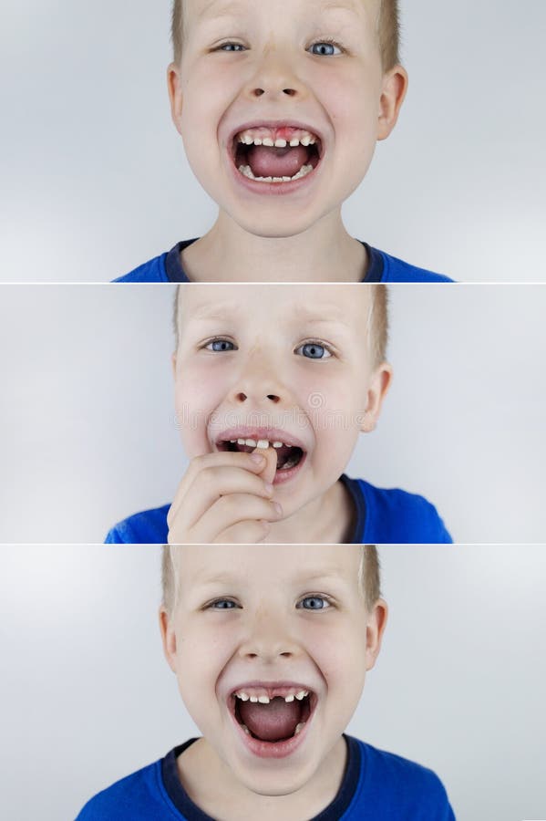 之前和之后. 掉下乳牙. 照片中的金发男孩有一颗松散的乳牙，而在另一张照片中，它已经跌倒