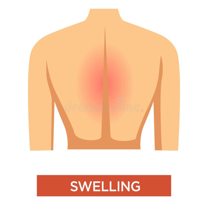 Swelling symptom in spine, person with swollen painful back, arthritis sign or injury reaction, inflammation, health issue concept, isolated colorful flat vector illustration on white background. Swelling symptom in spine, person with swollen painful back, arthritis sign or injury reaction, inflammation, health issue concept, isolated colorful flat vector illustration on white background