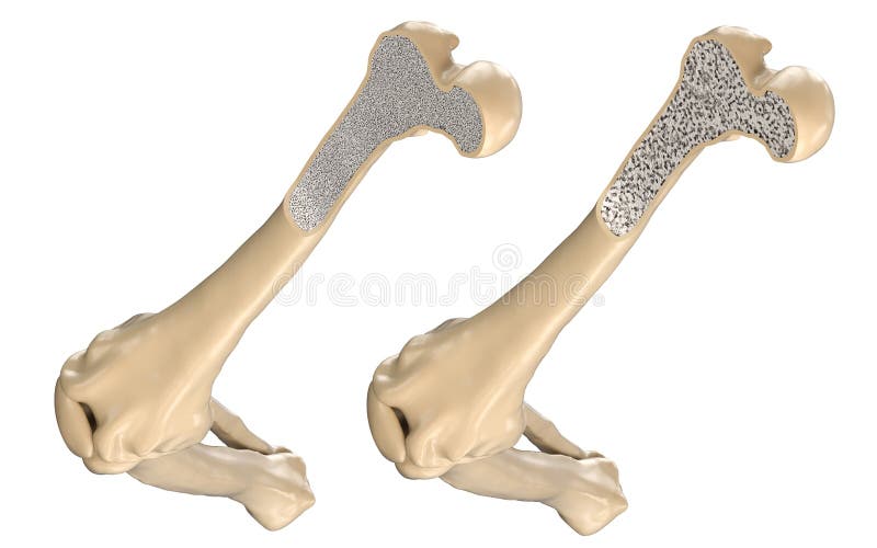 Human thigh bone - normal and with osteoporosis. 3D illustration. Human thigh bone - normal and with osteoporosis. 3D illustration