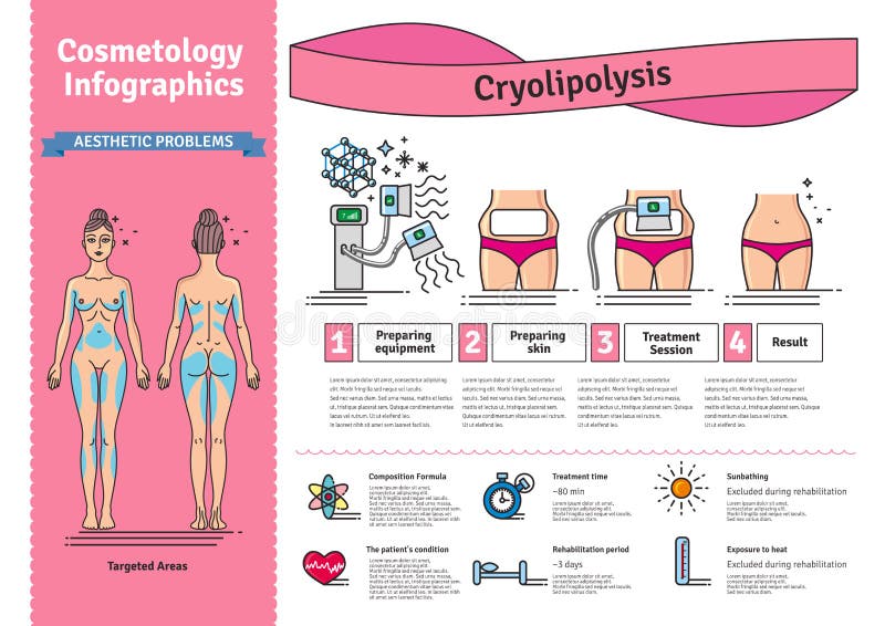 Vector Illustrated set with salon cosmetology Cryolipolysis treatment. Infographics with icons of medical cosmetic procedures for body. Vector Illustrated set with salon cosmetology Cryolipolysis treatment. Infographics with icons of medical cosmetic procedures for body.