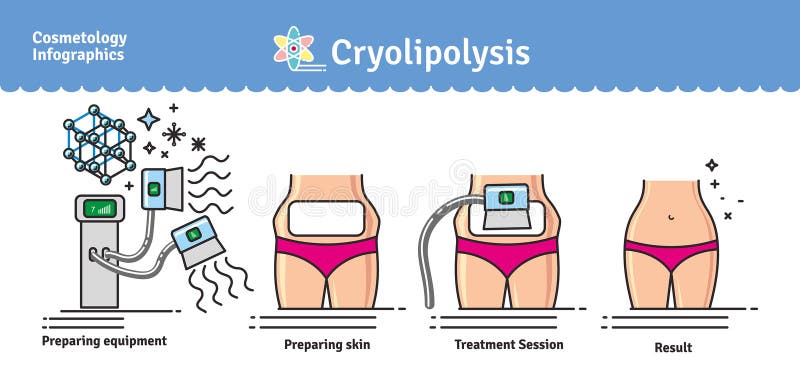 Vector Illustrated set with salon cosmetology Cryolipolysis treatment. Infographics with icons of medical cosmetic procedures for body. Vector Illustrated set with salon cosmetology Cryolipolysis treatment. Infographics with icons of medical cosmetic procedures for body.