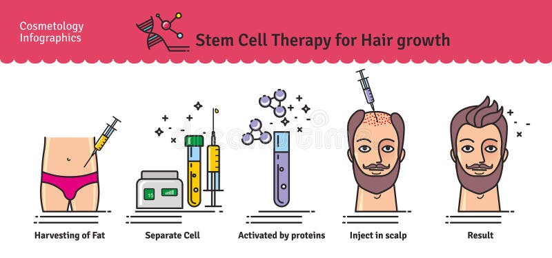 Vector Illustrated set with cosmetology stem cell therapy for hair growth. Infographics with icons of medical cosmetic procedures. Vector Illustrated set with cosmetology stem cell therapy for hair growth. Infographics with icons of medical cosmetic procedures.