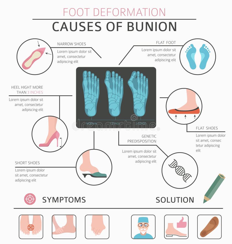 Foot deformation as medical desease infographic. Causes of bunion. Vector illustration. Foot deformation as medical desease infographic. Causes of bunion. Vector illustration