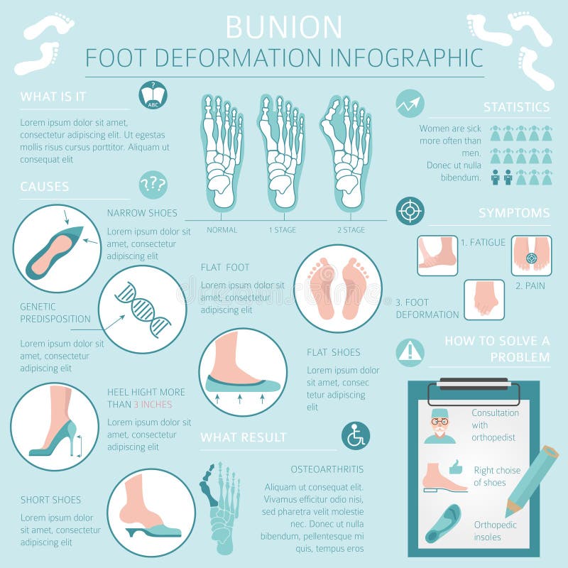 Foot deformation as medical desease infographic. Causes of bunion. Vector illustration. Foot deformation as medical desease infographic. Causes of bunion. Vector illustration