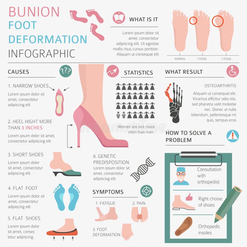 Foot deformation as medical desease infographic. Causes of bunion. Vector illustration. Foot deformation as medical desease infographic. Causes of bunion. Vector illustration