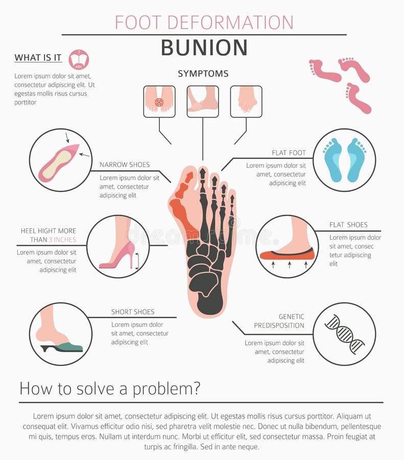 Foot deformation as medical desease infographic. Causes of bunion. Vector illustration. Foot deformation as medical desease infographic. Causes of bunion. Vector illustration