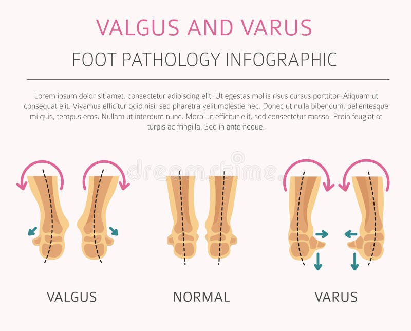 Foot deformation as medical desease infographic. Valgus and varus defect. Vector illustration. Foot deformation as medical desease infographic. Valgus and varus defect. Vector illustration