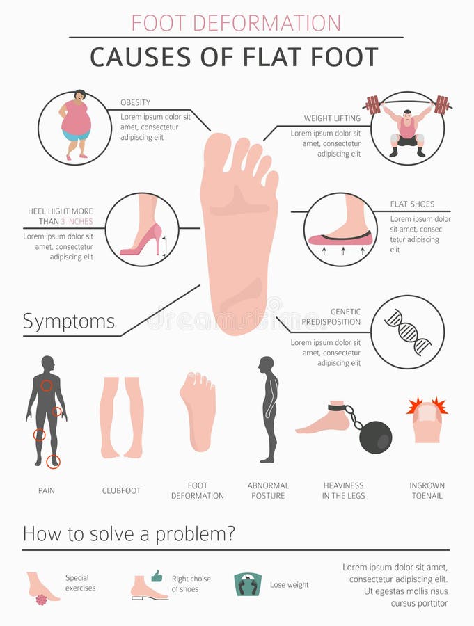 Foot deformation as medical desease infographic. Causes of Flat foot. Vector illustration. Foot deformation as medical desease infographic. Causes of Flat foot. Vector illustration