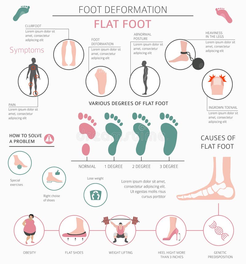 Foot deformation as medical desease infographic. Causes of Flat foot. Vector illustration. Foot deformation as medical desease infographic. Causes of Flat foot. Vector illustration