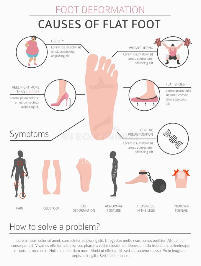 Foot deformation as medical desease infographic. Causes of Flat foot. Vector illustration. Foot deformation as medical desease infographic. Causes of Flat foot. Vector illustration