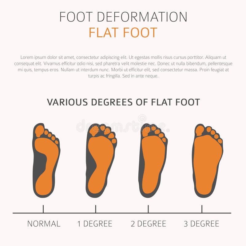 Foot deformation as medical desease infographic. Causes of Flat. Vector illustrations. Foot deformation as medical desease infographic. Causes of Flat. Vector illustrations