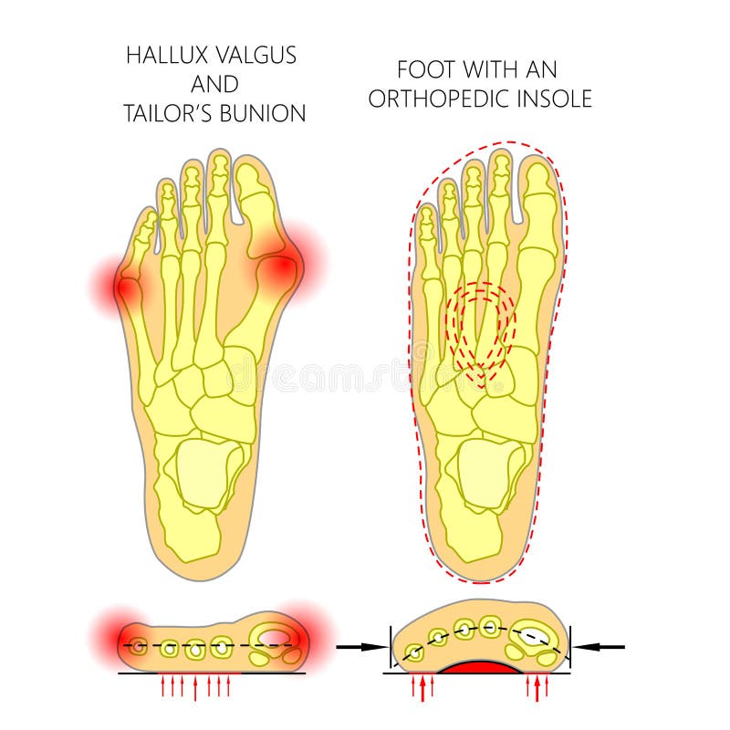 Deviation of the first and the fifth metatarsals transverse flatfoot with orthopedic insole. Used: gradient, transparency, blend mode. Deviation of the first and the fifth metatarsals transverse flatfoot with orthopedic insole. Used: gradient, transparency, blend mode.