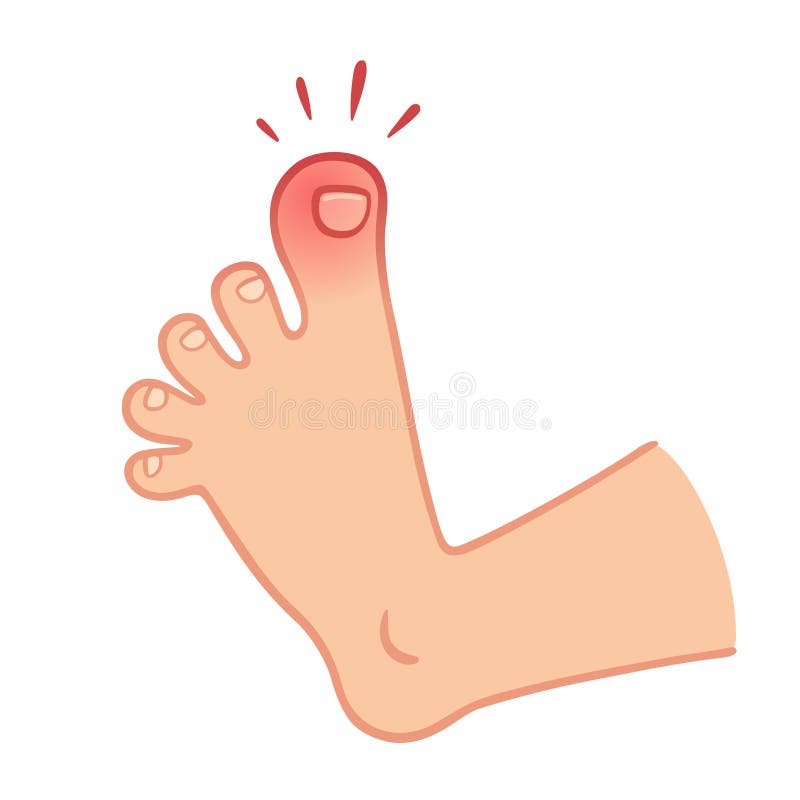 Cartoon foot with swollen stubbed toe, pain and trauma vector illustration. Cartoon foot with swollen stubbed toe, pain and trauma vector illustration.