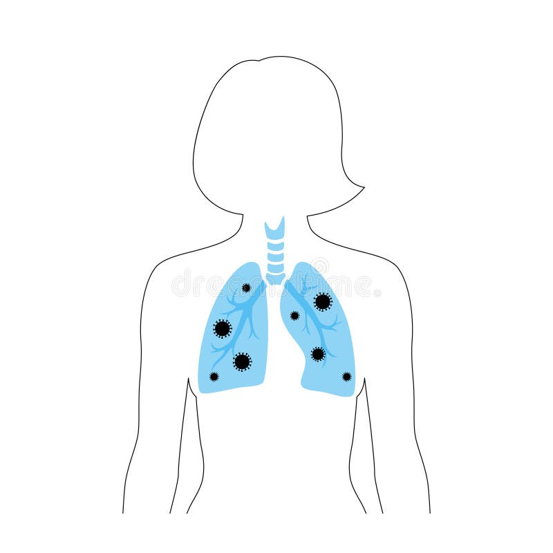 Woman lungs with virus infection. Illness and coronavirus epidemic concept. Vector isolated flat illustration. Medical, educational or science bannern. Woman lungs with virus infection. Illness and coronavirus epidemic concept. Vector isolated flat illustration. Medical, educational or science bannern