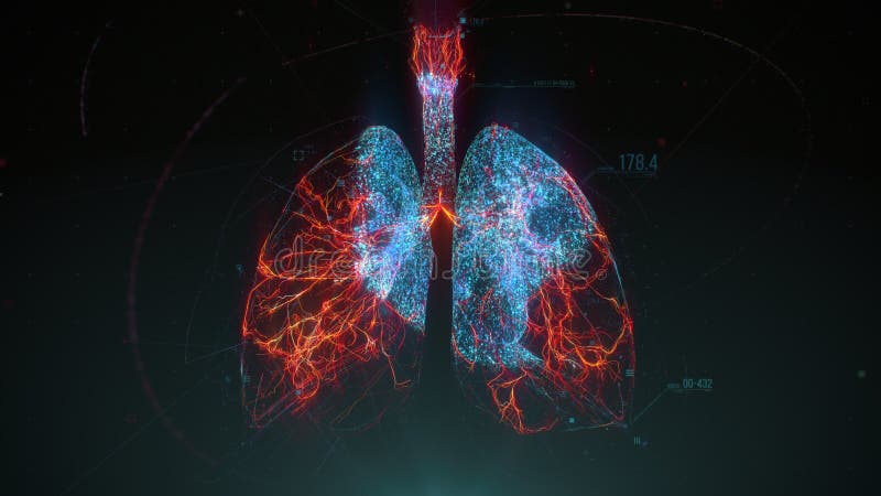 呼吸系统感染. 肺炎