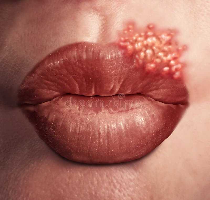 Cold sore herpes virus medical health concept as human lips with an outbreak of swollen fever blisters as an infection on skin. Cold sore herpes virus medical health concept as human lips with an outbreak of swollen fever blisters as an infection on skin.