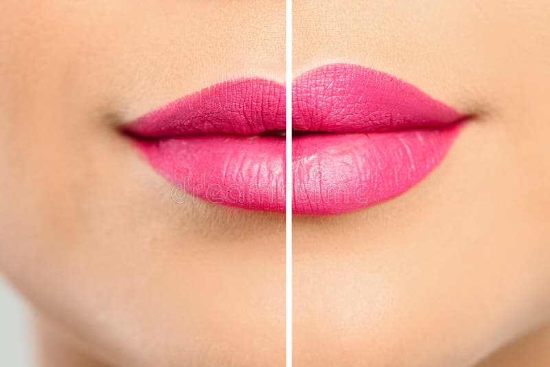 女性唇部矫正手术前后对比 图库摄影