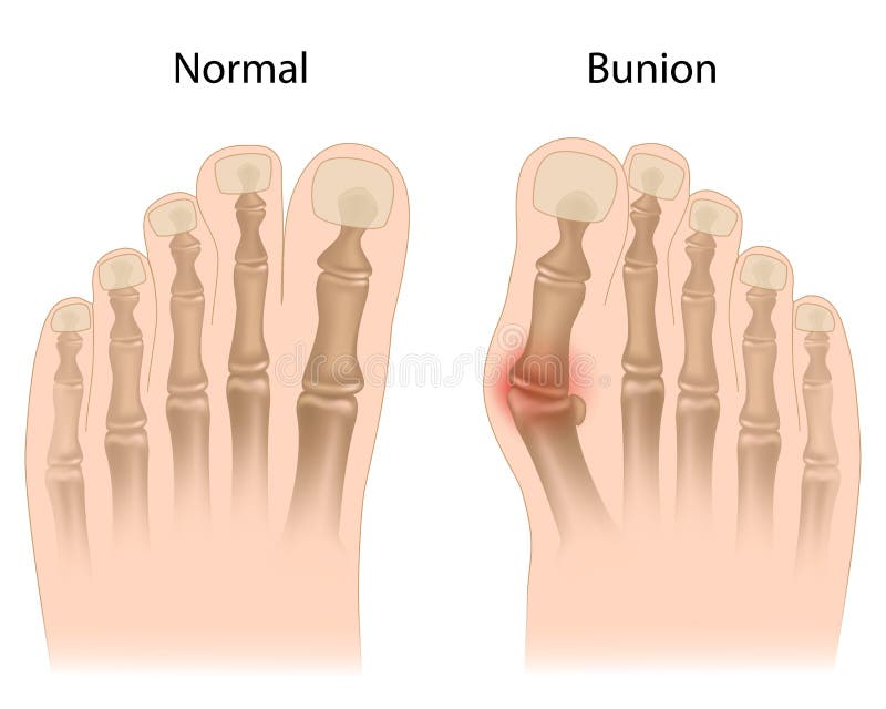 Deformity of the big toe joint usually due to tight fitting shoes, eps10. Deformity of the big toe joint usually due to tight fitting shoes, eps10