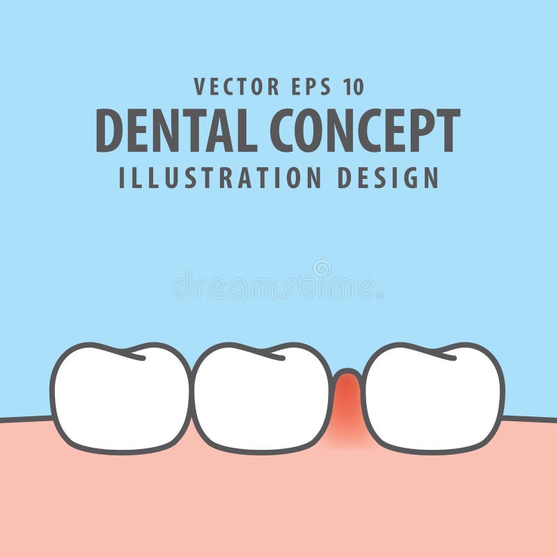 Swollen inflammation gums with teeth illustration vector on blue background. Dental concept. Swollen inflammation gums with teeth illustration vector on blue background. Dental concept.