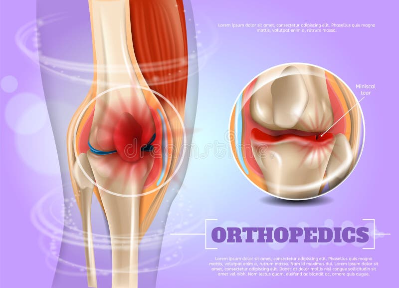 Realistic Illustration Orthopedics Medicine in 3d. Banner Vector Image Closeup Anatomy and Structure Human Knee Joint. Infographics Study Rupture and Treatment Methods Miniscal Tear. Realistic Illustration Orthopedics Medicine in 3d. Banner Vector Image Closeup Anatomy and Structure Human Knee Joint. Infographics Study Rupture and Treatment Methods Miniscal Tear