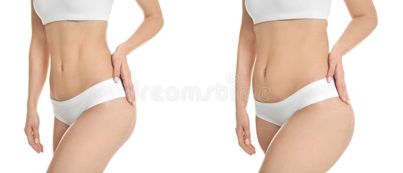 年轻女子抽脂手术前后对比 免版税库存图片