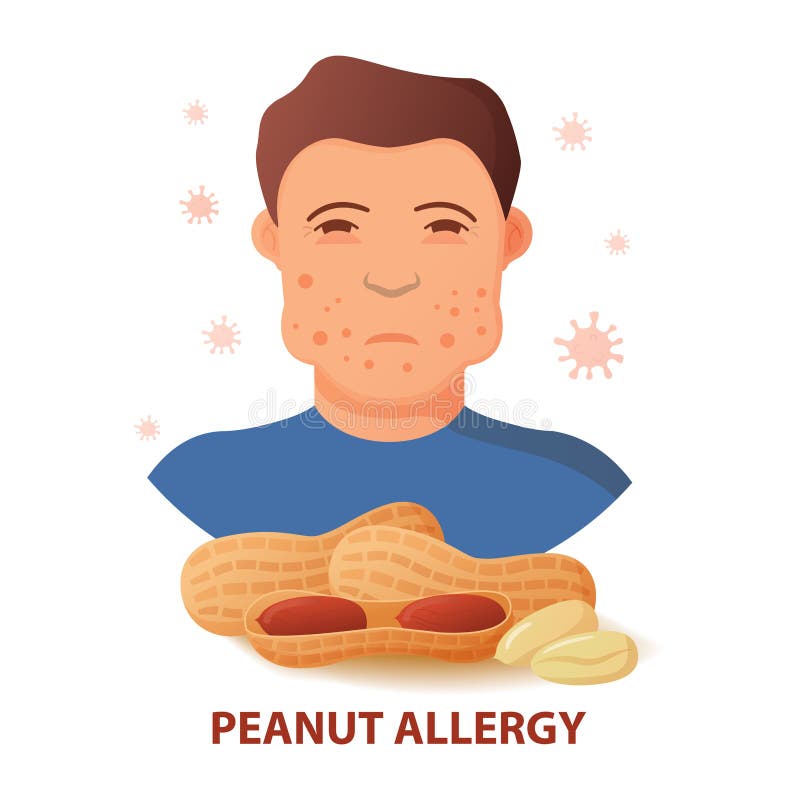 Allergic reaction to peanuts.Flat illustration vector.Isolated on a white background. Allergic reaction to peanuts.Flat illustration vector.Isolated on a white background.