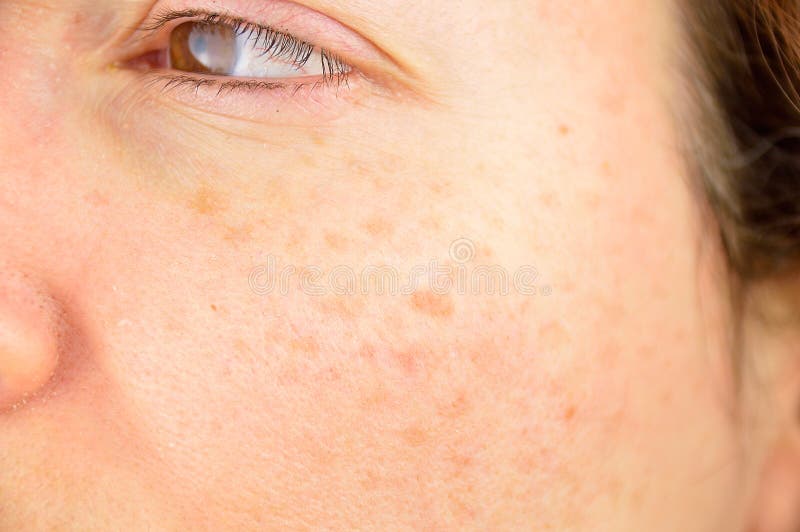 Closeup of a woman cheek with liver spot causes by the large exposition sun. Closeup of a woman cheek with liver spot causes by the large exposition sun