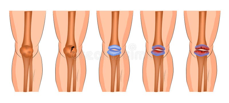 Arthritis of the knee joint, protrusion, fracture of the patella. Arthritis of the knee joint, protrusion, fracture of the patella