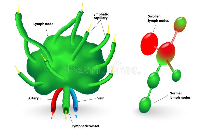 Lymph node, lymph gland. Schematic diagram of lymph node showing the flow of lymph. Swollen lymph nodes and Normal lymph nodes. Lymph node, lymph gland. Schematic diagram of lymph node showing the flow of lymph. Swollen lymph nodes and Normal lymph nodes.