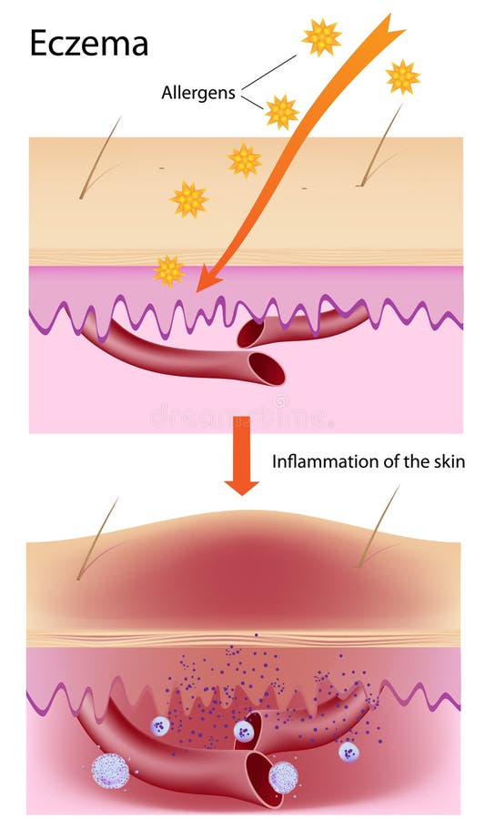 Diagram showing skin inflammation, eps8, gradient and mesh printing compatible. Diagram showing skin inflammation, eps8, gradient and mesh printing compatible