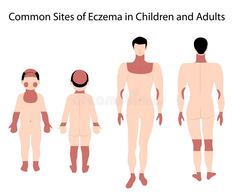 Diagram showing sites of eczema, eps8,. Diagram showing sites of eczema, eps8,