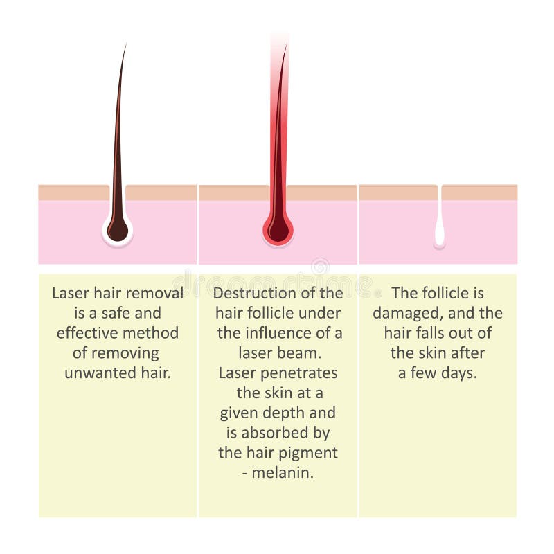 Scheme of laser hair removal. Stepup Description of the cosmetology procedure. Scheme of laser hair removal. Stepup Description of the cosmetology procedure.