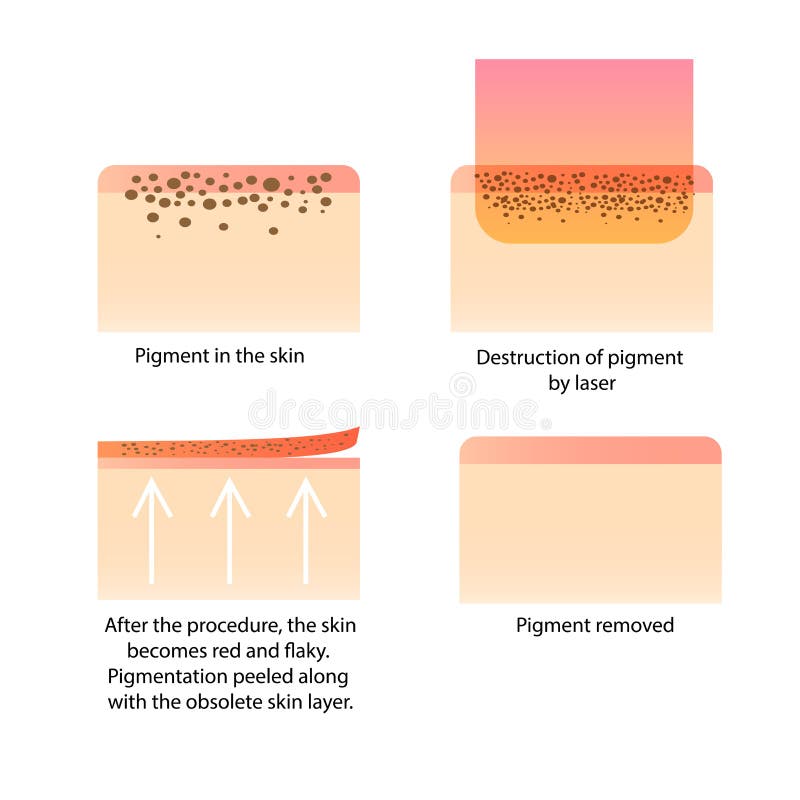 Laser cosmetology. Procedure for removing tattoo and freckles, old spots, birthmark, dark spot, pigment. Infographics. Laser cosmetology. Procedure for removing tattoo and freckles, old spots, birthmark, dark spot, pigment. Infographics