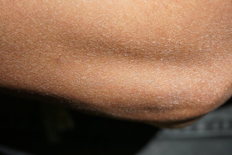 片状在坏健康左胳膊干性皮肤 库存图片. 图片 包括有 表皮, 破裂, 背包, 片状, 干燥, 人力, 情况 - 109059595