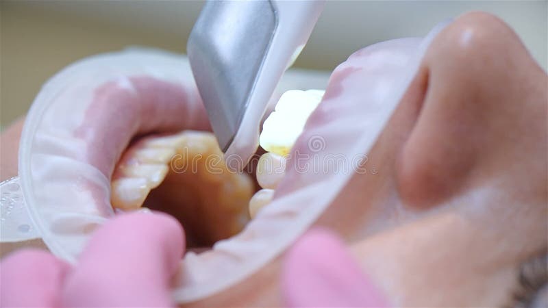 牙内扫描正畸扫描在牙科临床中的应用.