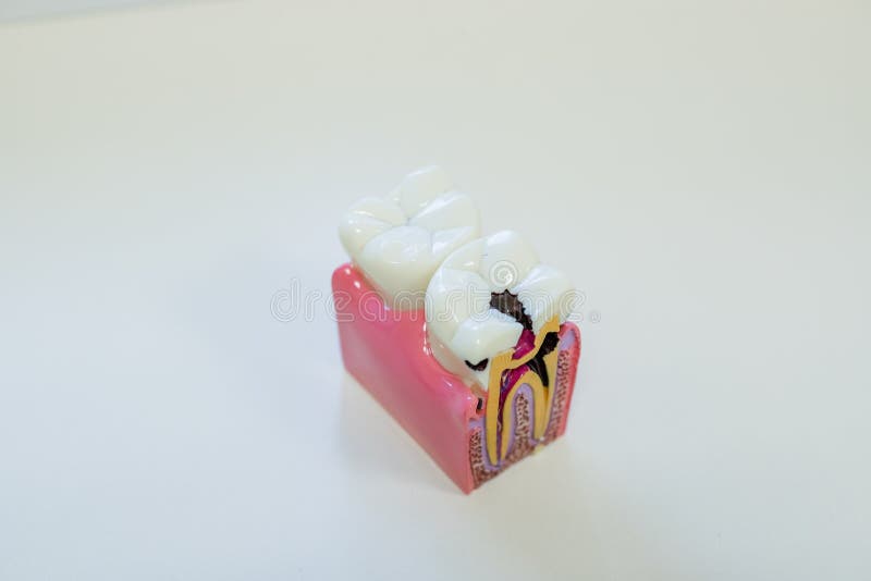 牙齿模型礼物共同的牙齿疾病例如龋,智齿 口头健康 教育的牙模型 顶层 图库摄影 牙齿模型礼物共同的牙齿疾病例如龋,智齿 口头健康 教育的牙模型 顶层 图库摄影
