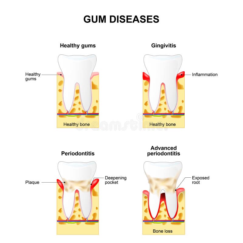 Gum disease: Gingivitis and Periodontitis. Gingivitis - the gums are swollen, bone is healthy. Periodontitis - the gums are swollen and the bone is also inflamed. Gum disease: Gingivitis and Periodontitis. Gingivitis - the gums are swollen, bone is healthy. Periodontitis - the gums are swollen and the bone is also inflamed.