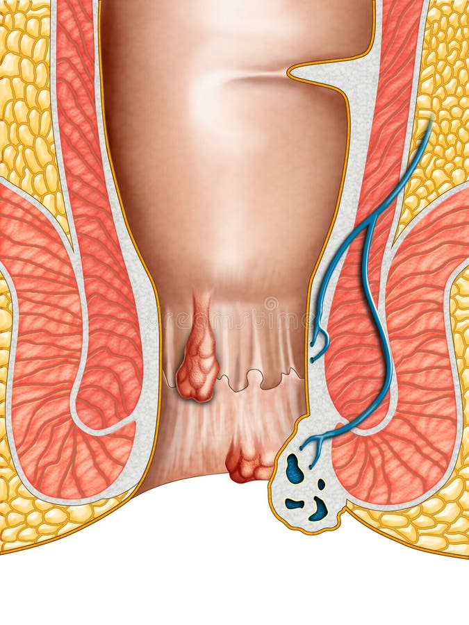 Anatomical drawing showing internal and external hemorrhoids. Digital illustration. Anatomical drawing showing internal and external hemorrhoids. Digital illustration.