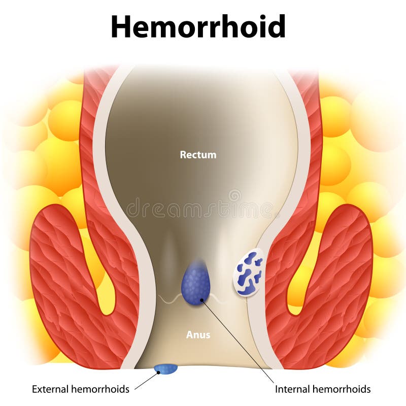 Diagram the anal anatomy. internal and external hemorrhoids. Human anatomy. Diagram the anal anatomy. internal and external hemorrhoids. Human anatomy