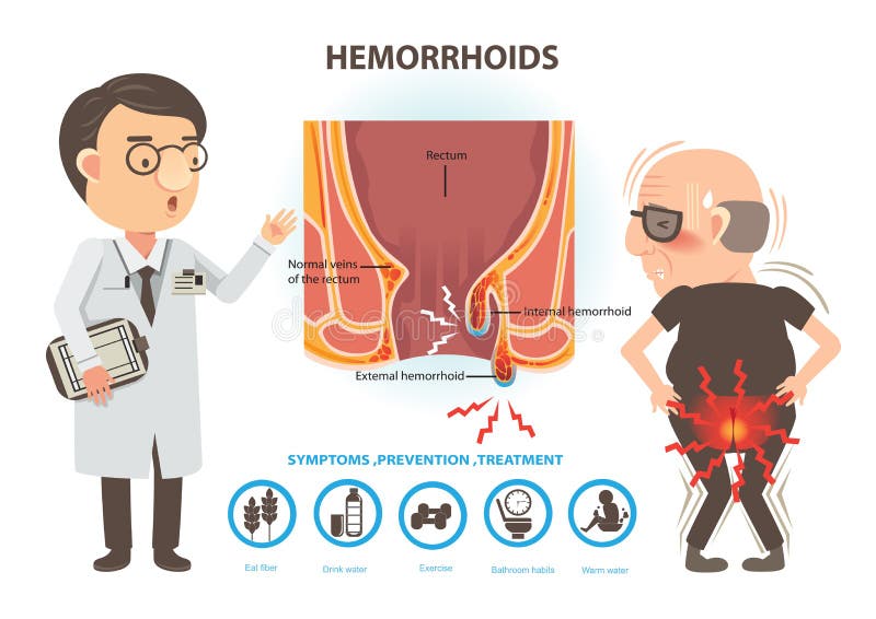 Man ache of hemorrhoids and Doctors to talk to patients. Diagram the anal anatomy. internal and external hemorrhoids. Man ache of hemorrhoids and Doctors to talk to patients. Diagram the anal anatomy. internal and external hemorrhoids