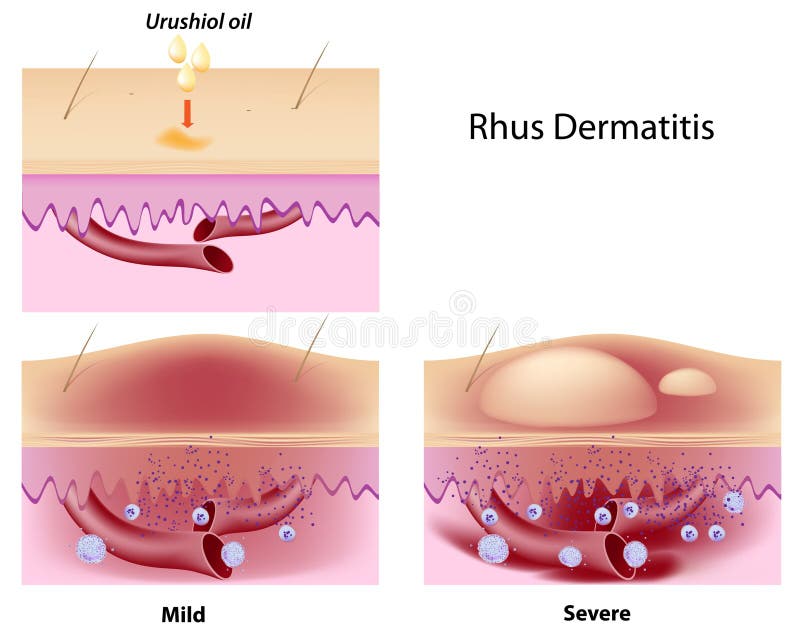 Urushiol oil induced contact dermatitis, eps8. Urushiol oil induced contact dermatitis, eps8