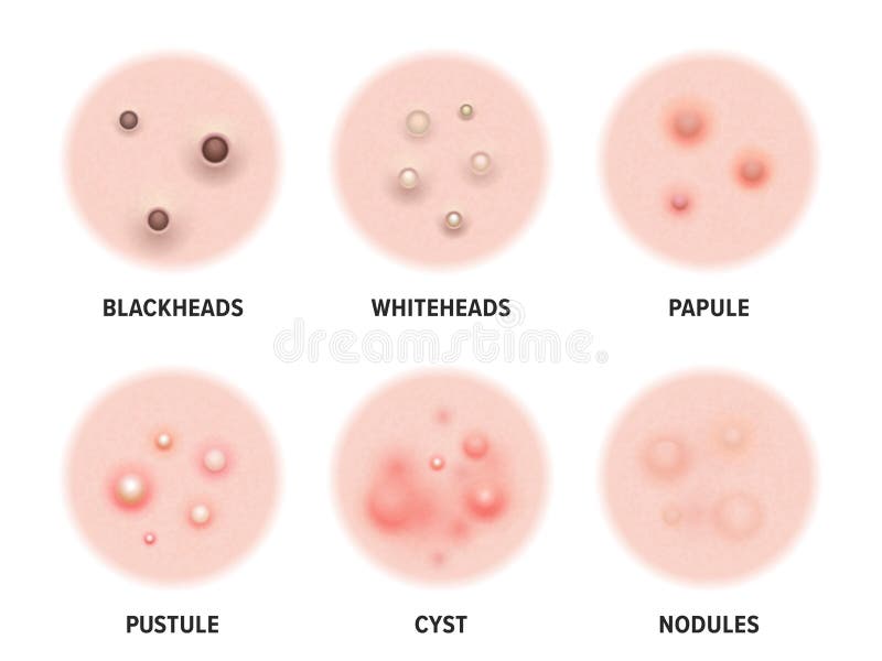 Skin acne types diagram. Vector skin disease pimples blackheads and comedones, cosmetology and skincare problems treatment package icons. Skin acne types diagram. Vector skin disease pimples blackheads and comedones, cosmetology and skincare problems treatment package icons