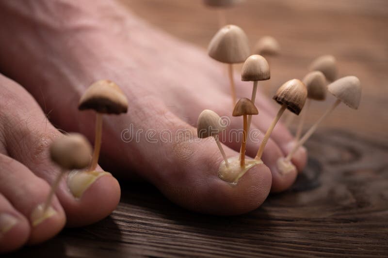 真菌从脚上的钉板上生长. 甲虫皮肤和甲虫感染的概念. 两条长着真菌的腿 免版税库存照片