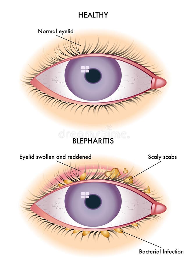 Medical illustration of the symptoms of blepharitis. Medical illustration of the symptoms of blepharitis